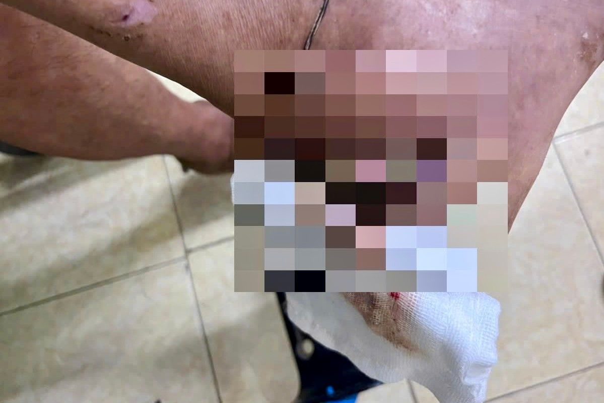 Bàn chân của ông B. bị uốn ván toàn thể, đứt gân gót chân trái (gân Achille) và nhiễm trùng hoại tử nặng tại vết thương. Ảnh: Linh Trang