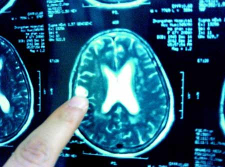 Ổ trùng được chụp từ trong não bệnh nhân