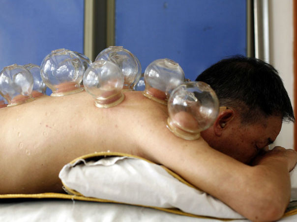 Giác hơi không đúng phương pháp có thể nguy hiểm đến tính mạng