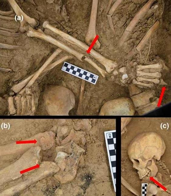 Hình (a) là vết gãy xương không lành của người chồng, hình (b) dấu hiệu viêm xương chi dưới ở hài cốt người chồng, hình (c) hình ảnh chiếc răng bị rụng ở hài cốt người vợ.