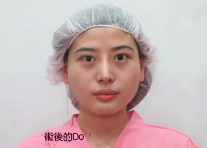 Khuôn mặt của Dora trước khi phẫu thuật