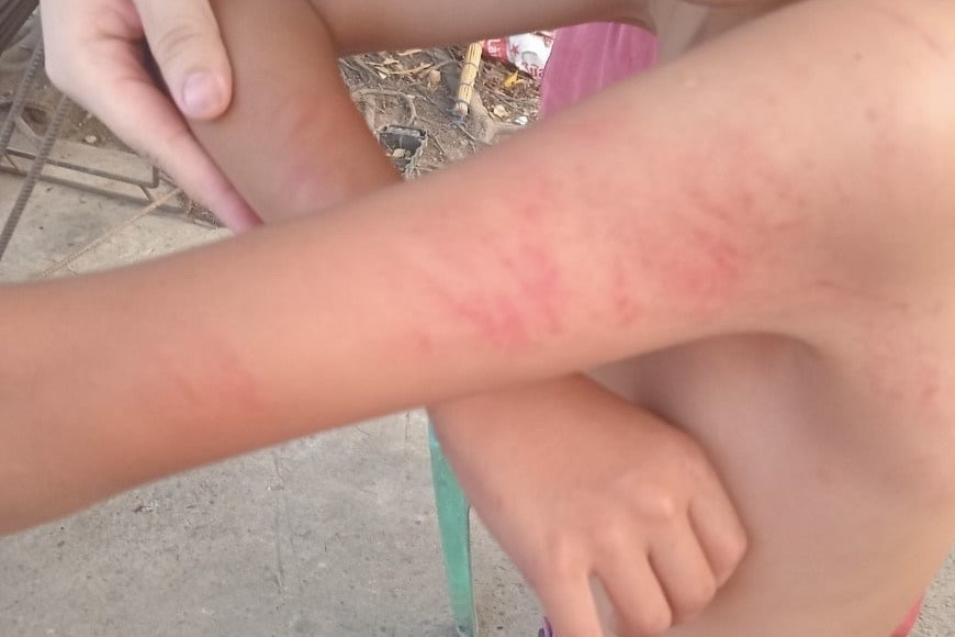 Học sinh bị nhiều vết xước đỏ trên tay. Ảnh: VNN.