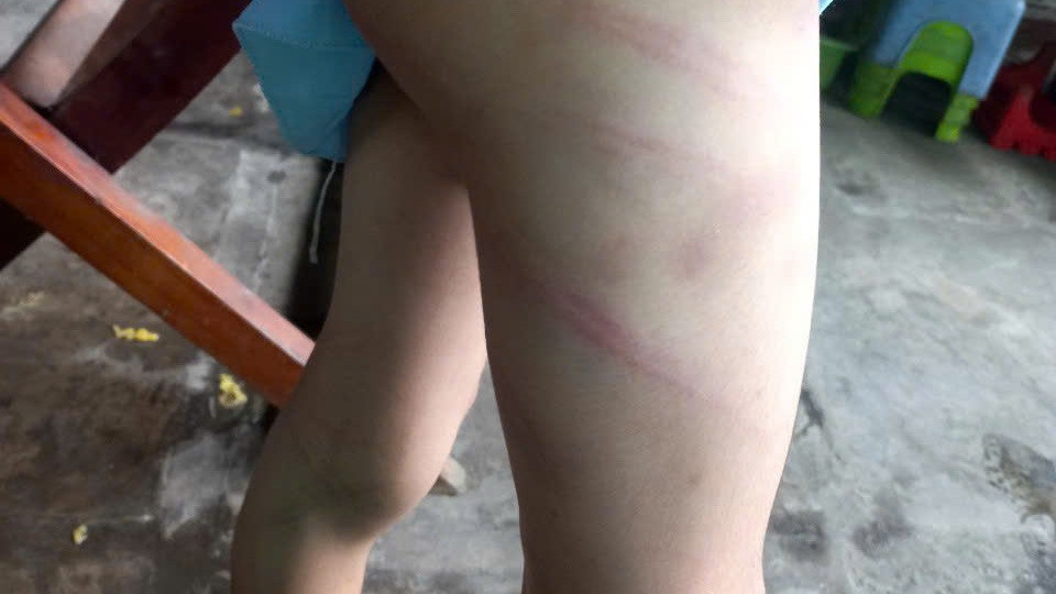 Nhiều vết thương trên cơ thể bé gái.