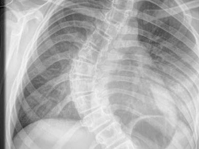 Ảnh chụp X-quang xương sống của Ellen