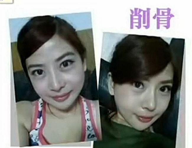 Theo một bác sĩ, phần cằm của bệnh nhân vẫn chưa linh hoạt lắm, phải mất từ 1 đến 1,5 tháng để khiến nó trở nên tự nhiên hơn