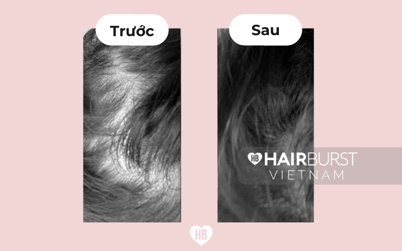 Đây là lựa chọn được nhiều phái đẹp ưu tiên để có mái tóc dày, hạn chế gãy rụng hiệu quả