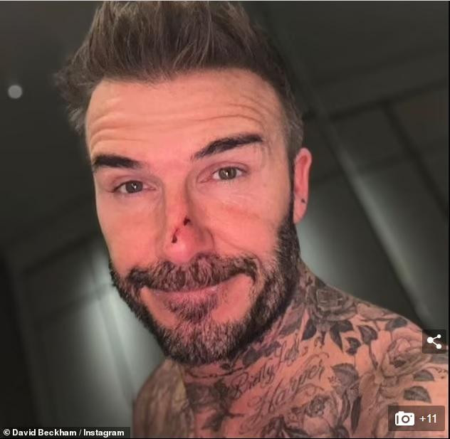 Beckham bị con gái cắn rách mũi trong lúc đùa giỡn.