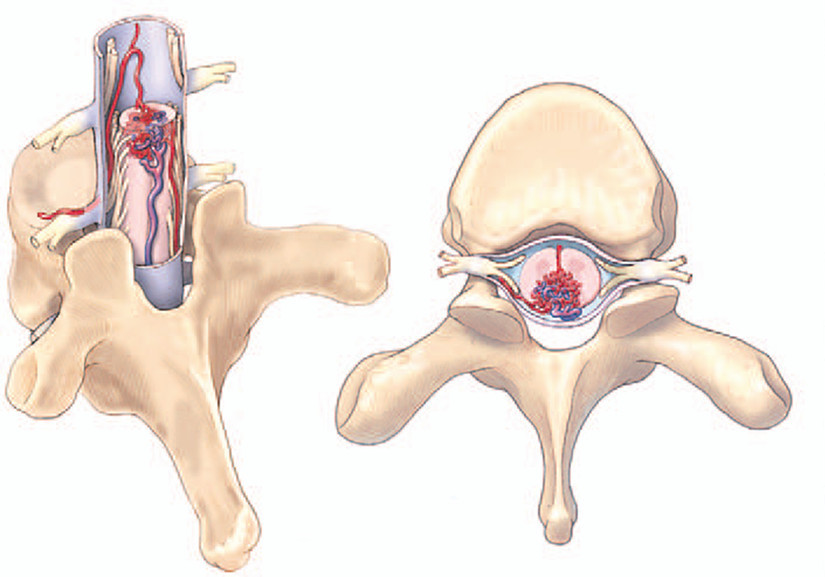 Dị dạng mạch máu tủy là nguyên nhân khiến người bệnh đột ngột liệt nửa người Dị dạng mạch máu tủy là nguyên nhân khiến người bệnh đột ngột liệt nửa người