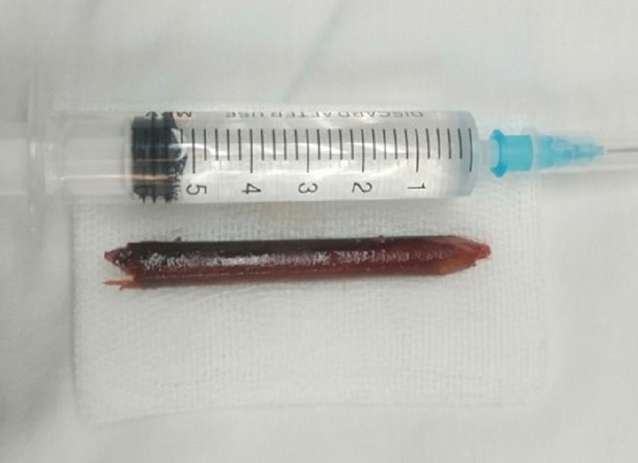 Dị vật là một phần của chiếc đũa đâm xuyên hốc mắt người bệnh được bác sĩ lấy ra ngoài