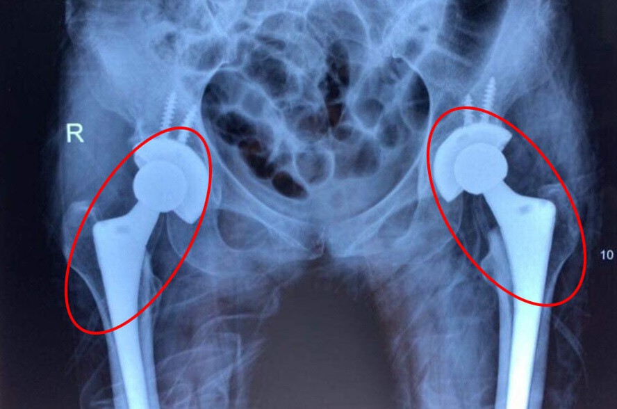 Nhiều bệnh nhân còn rất trẻ nhưng đã phải thay cả 2 khớp háng do bị mục xương