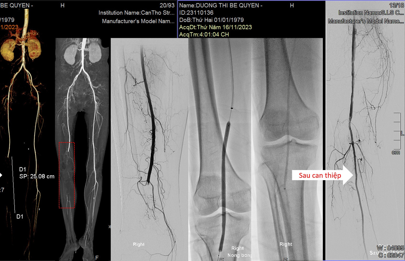 Hình ảnh mạch máu của bệnh nhân bị tắc, sau khi can thiệp đã được tái thông