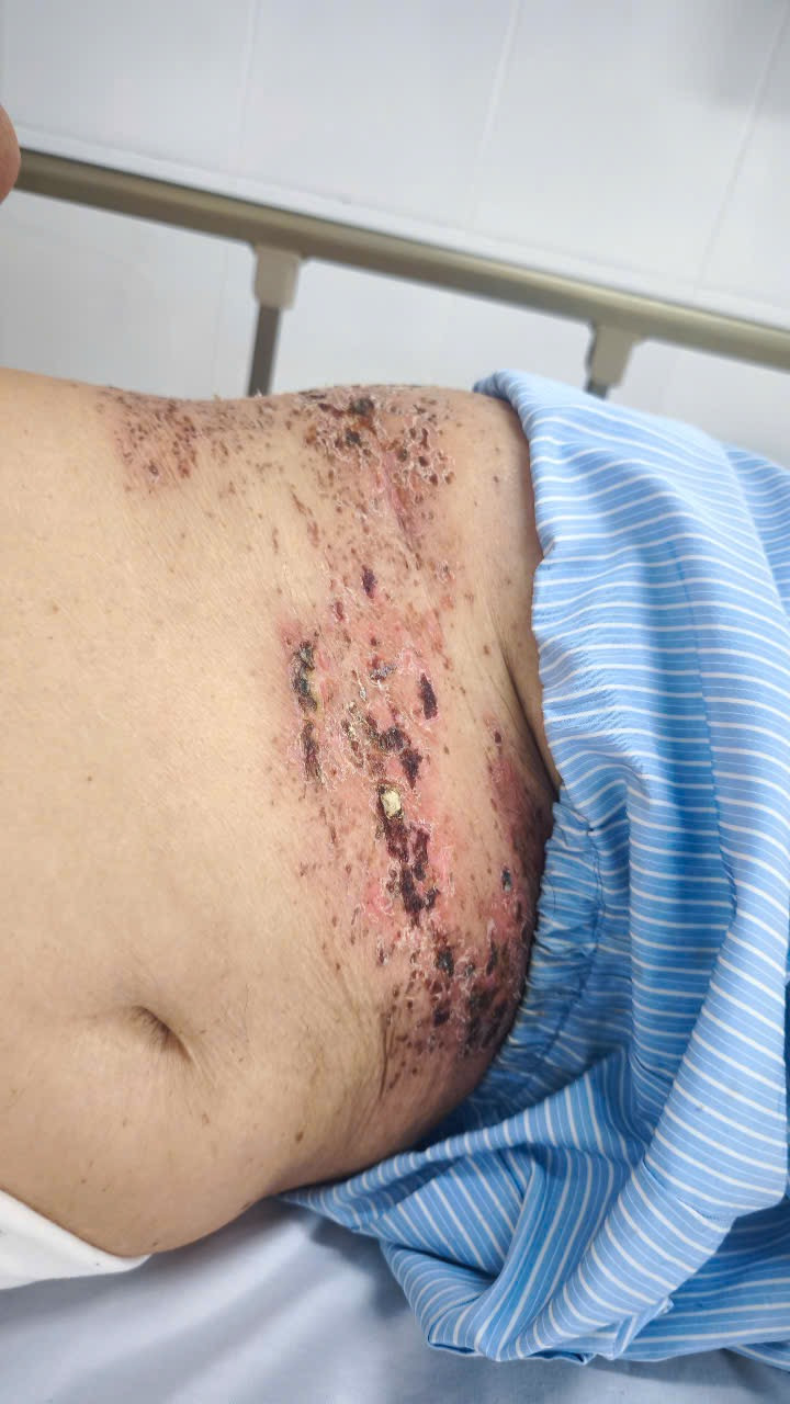 Bệnh nhân bị tổn thương da nghiêm trọng và đau dây thần kinh kéo dài Bệnh nhân bị tổn thương da nghiêm trọng và đau dây thần kinh kéo dài