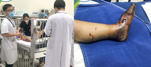Trẻ nhập viện trong tình trạng nặng nề, hoại tử bàn chân
