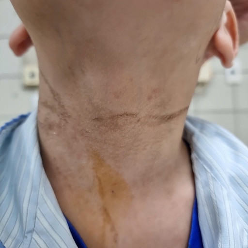 Trẻ suýt mất mạng vì dây rút quần thắt chặt cổ. Trẻ suýt mất mạng vì dây rút quần thắt chặt cổ.