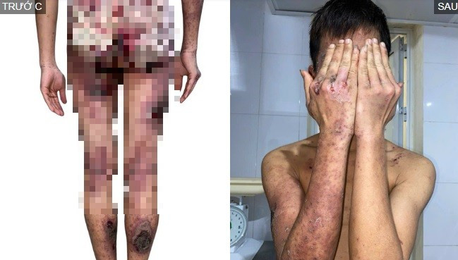 Đắp kiến ba khoang chữa ngứa, thanh niên 25 tuổi bị tổn thương da toàn thân Đắp kiến ba khoang chữa ngứa, thanh niên 25 tuổi bị tổn thương da toàn thân