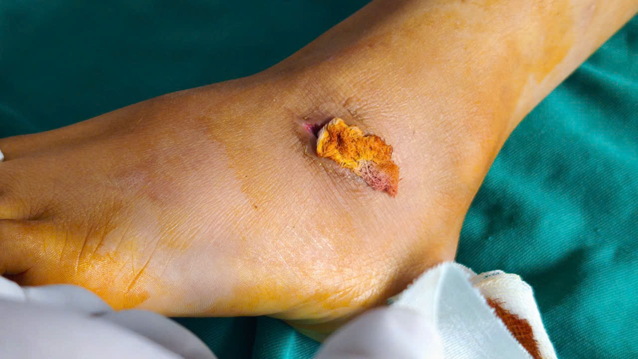 Từ vết thương nhỏ nhưng bé 7 tuổi bị suy thận và hàng loạt biến chứng