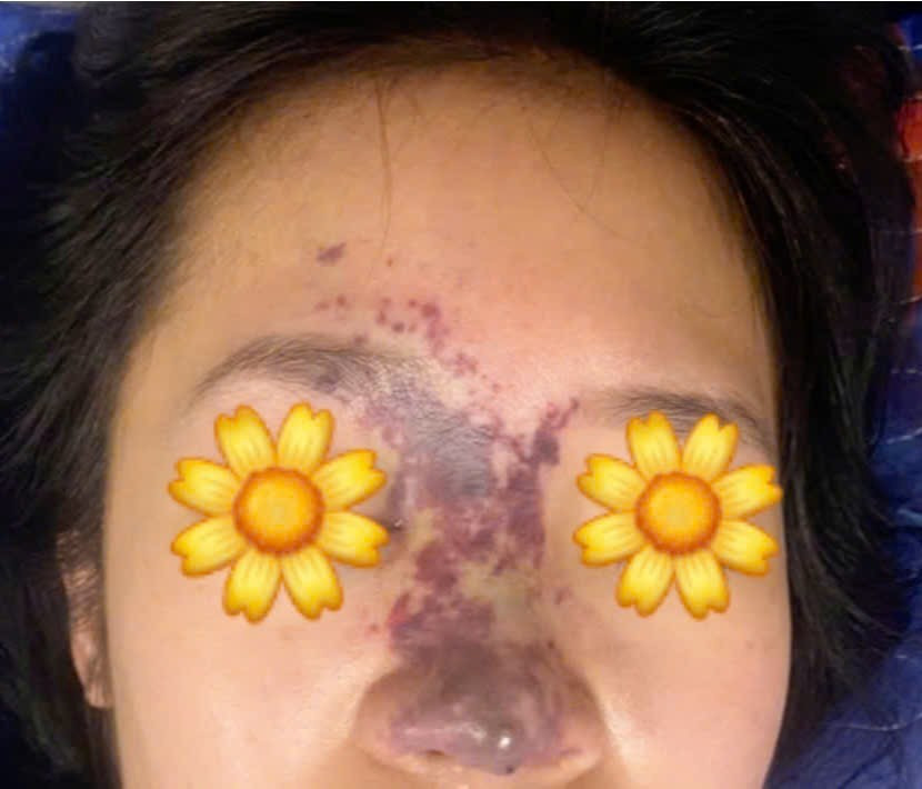 Bệnh nhân thâm tím vùng mũi lan lên mắt phải sau khi tiêm filler ở cơ sở spa Bệnh nhân thâm tím vùng mũi lan lên mắt phải sau khi tiêm filler ở cơ sở spa