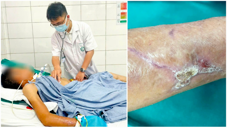 Bệnh nhân nam thợ xây bị uốn ván do ngã đập tay vào tấm gỗ. Bệnh nhân nam thợ xây bị uốn ván do ngã đập tay vào tấm gỗ.