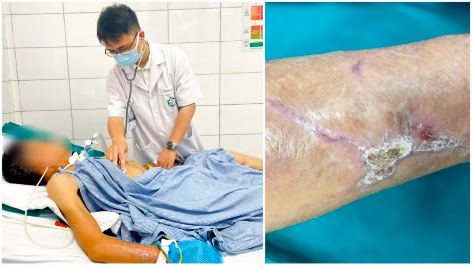Bệnh nhân nam thợ xây bị uốn ván do ngã đập tay vào tấm gỗ.