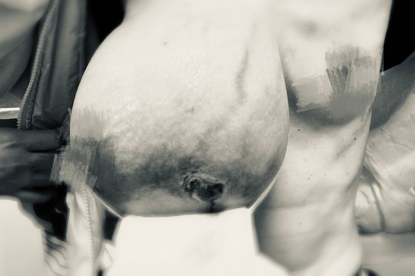 Khối u khổng lồ to như cây bắp cải trên cơ thể chị H.