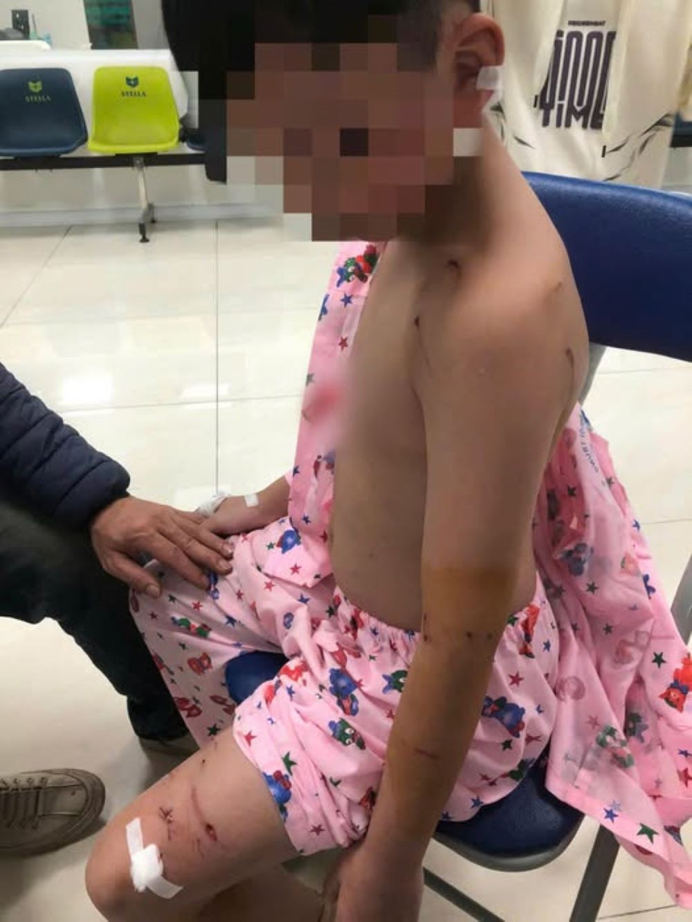 Cháu B.A với nhiều vết thương do chó cắn khi đi chúc Tết. Cháu B.A với nhiều vết thương do chó cắn khi đi chúc Tết.