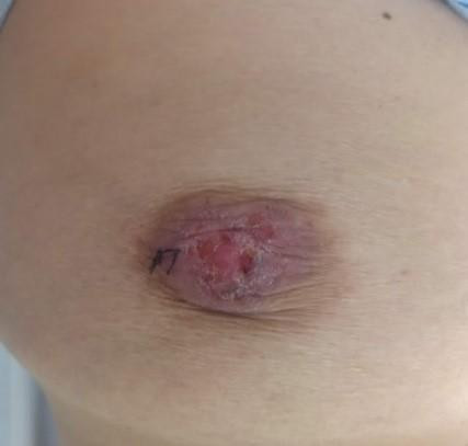 Biểu hiện Paget vú Biểu hiện Paget vú