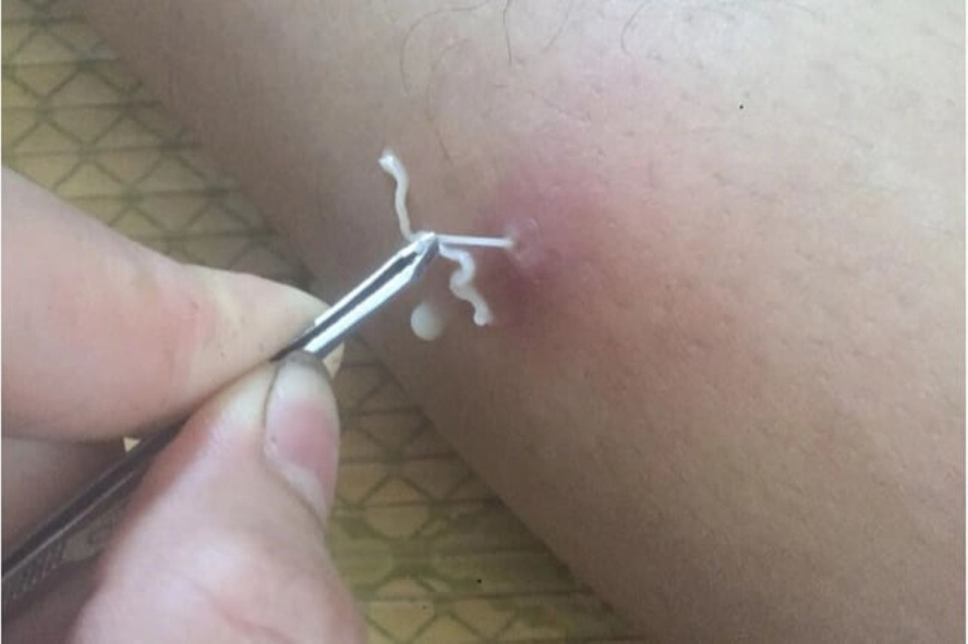 Gắp giun rồng ra khỏi cơ thể bệnh nhân Gắp giun rồng ra khỏi cơ thể bệnh nhân