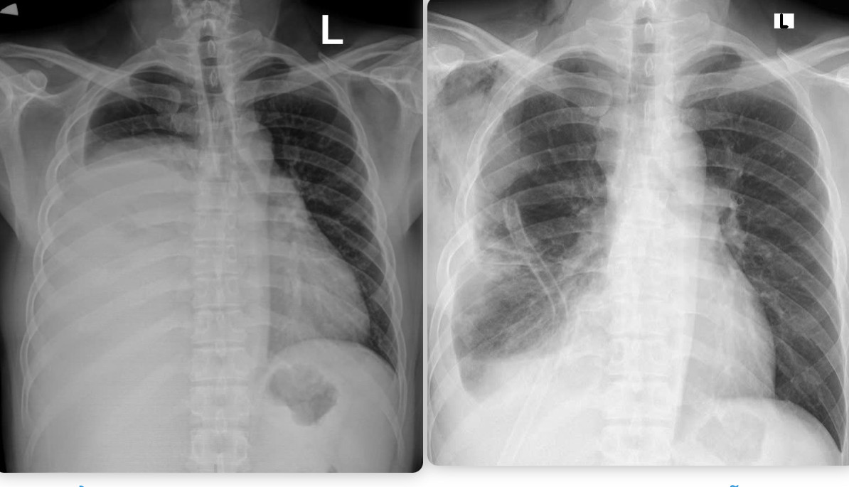 Hình ảnh phim chụp X.quang trước và sau khi phẫu thuật. Hình trước phẫu thuật (bên trái): Khối u xâm chiếm khoang ngực, gây xẹp gần như toàn bộ phổi phải. Hình ảnh phim chụp X.quang trước và sau khi phẫu thuật. Hình trước phẫu thuật (bên trái): Khối u xâm chiếm khoang ngực, gây xẹp gần như toàn bộ phổi phải.