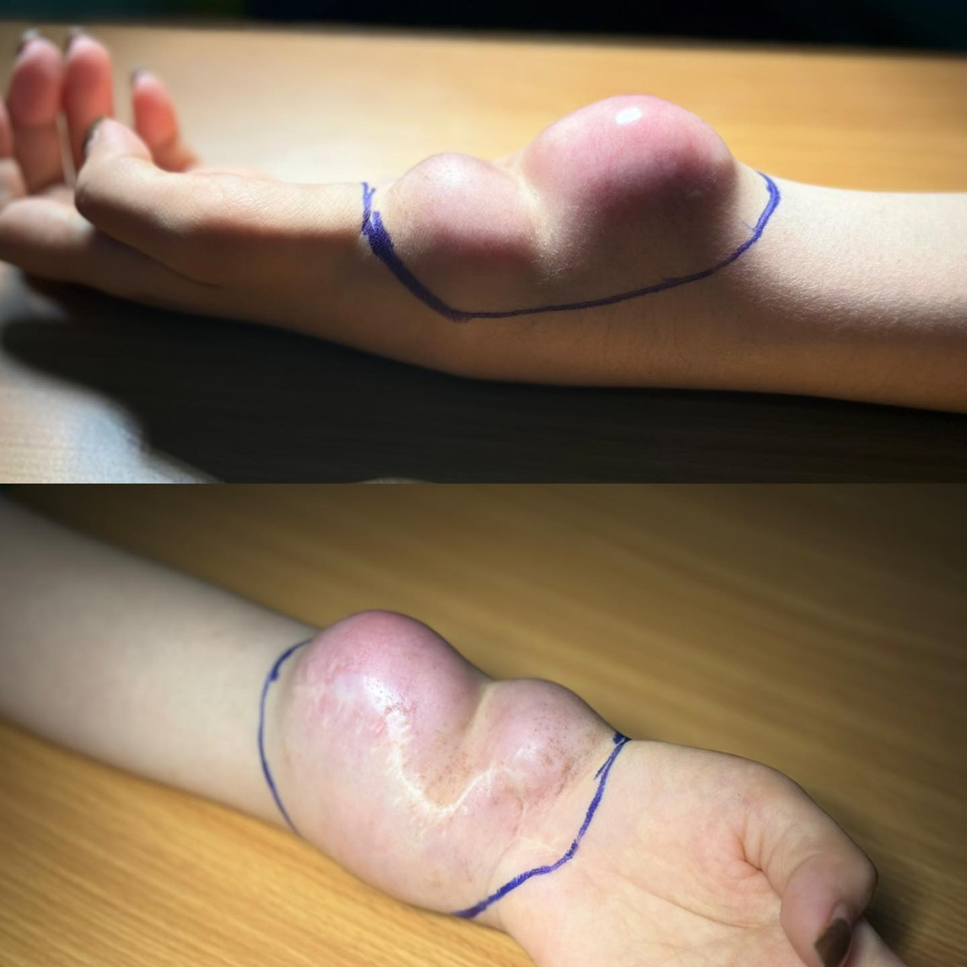 Các khối u mọc trên 2 cổ tay bệnh nhân. Các khối u mọc trên 2 cổ tay bệnh nhân.