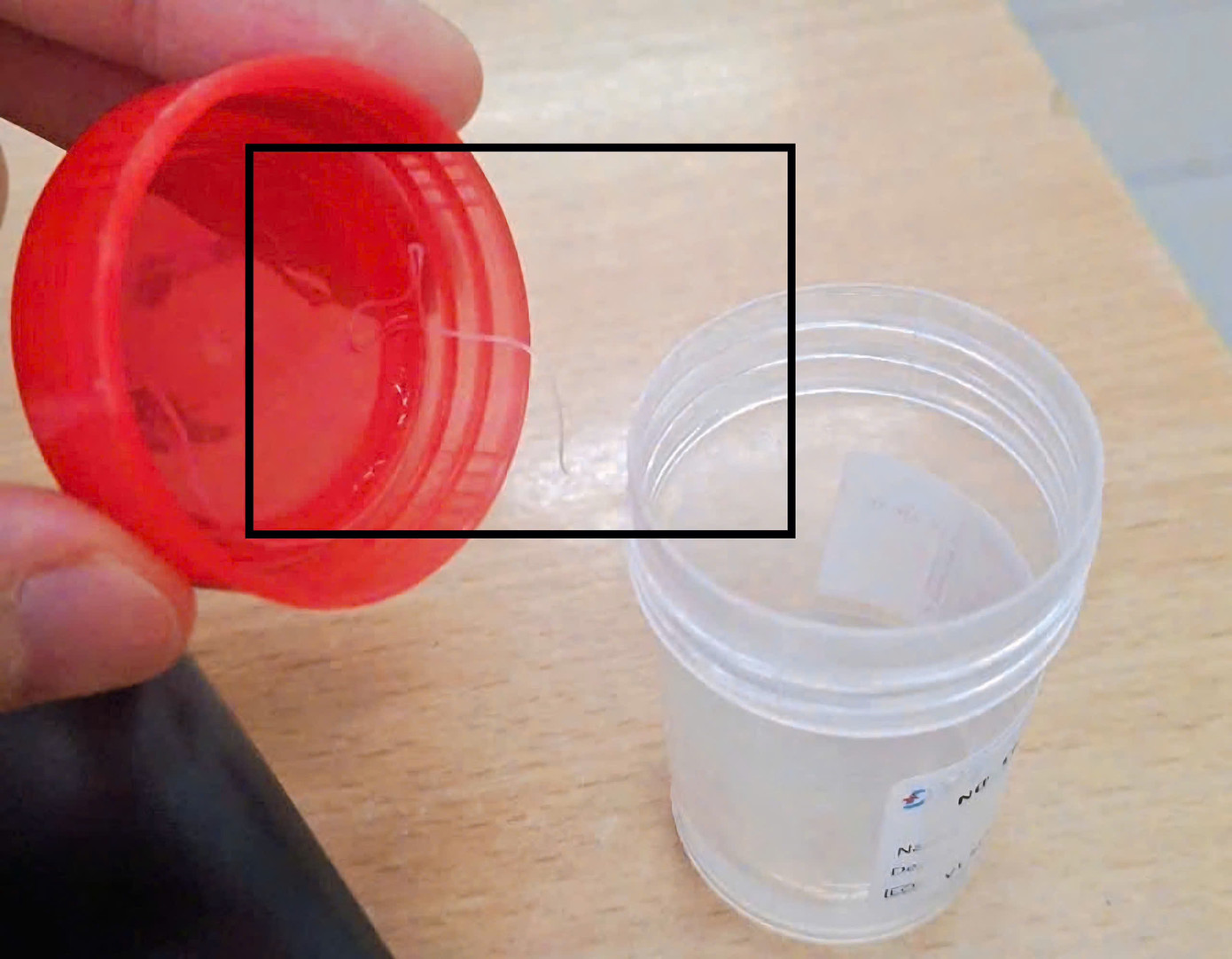 Kí sinh trùng dài gần 10cm sống trong mắt bệnh nhân được bác sĩ lấy ra.