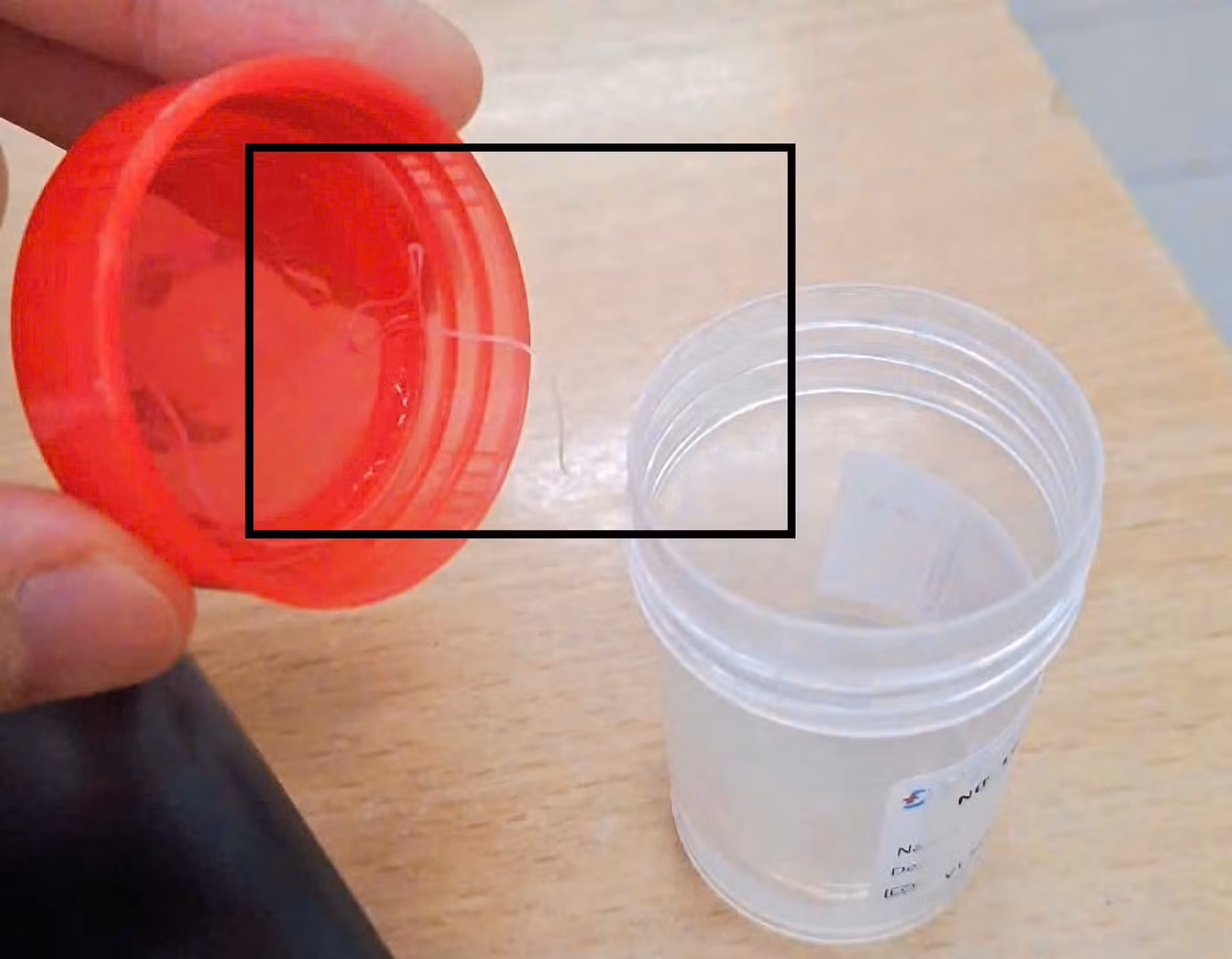 Kí sinh trùng dài gần 10cm sống trong mắt bệnh nhân được bác sĩ lấy ra. Kí sinh trùng dài gần 10cm sống trong mắt bệnh nhân được bác sĩ lấy ra.