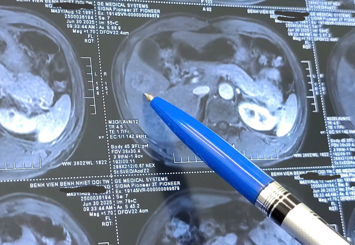 Khối u gan trong bụng bệnh nhân.