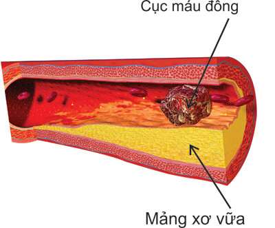 Cơ chế gây nhồi máu cơ tim