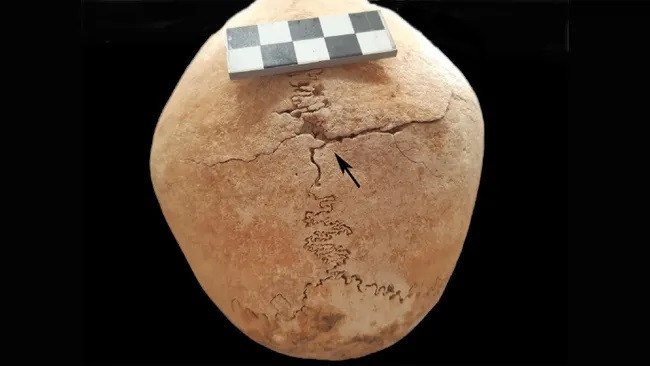 Một hộp sọ được phục hồi từ Zorita de los Canes với một vết thương xuyên thấu. (Ảnh: Tiến sĩ Carme Rissech, Giáo sư Lectora d'Anatomia Humana i Embriologia)