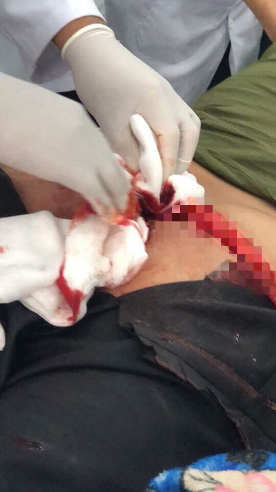 Ngồi xổm đi vệ sinh, nam thanh niên bị bồn cầu vỡ cứa rách mông ảnh 1