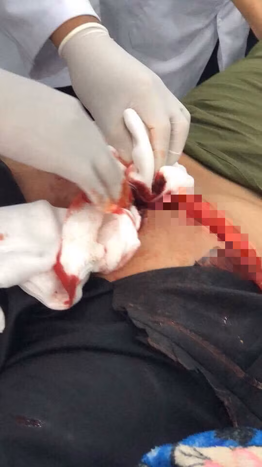 Ngồi xổm đi vệ sinh, nam thanh niên bị bồn cầu vỡ cứa rách mông ảnh 1