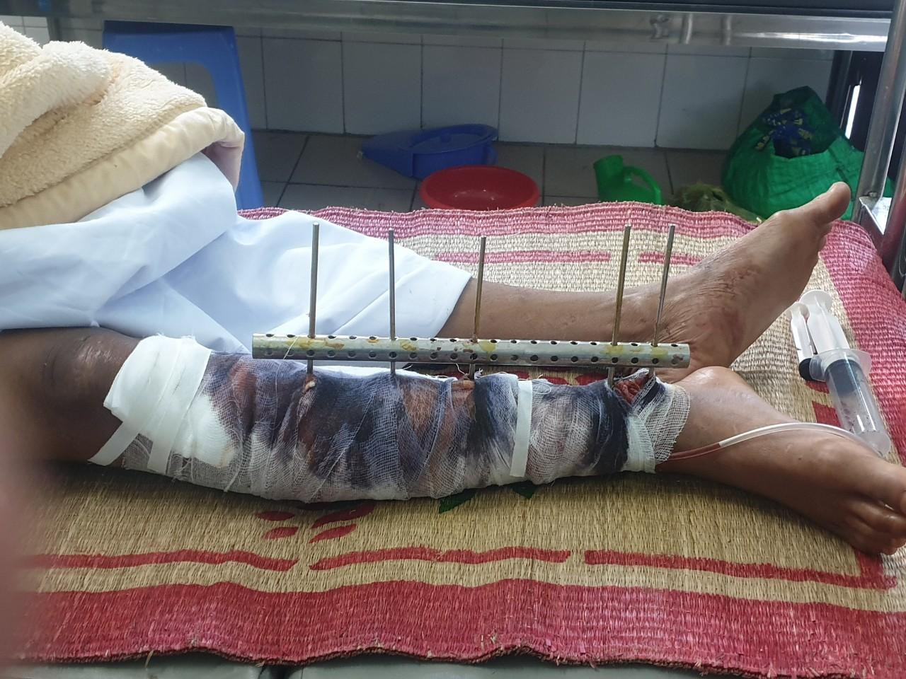 Ngư dân Đỗ Đức Long bị dập chân và đa chấn thương vùng đầu. Ngư dân Đỗ Đức Long bị dập chân và đa chấn thương vùng đầu.