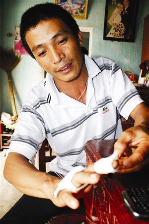 Anh Lý và vết thương do thuốc lá nổ.