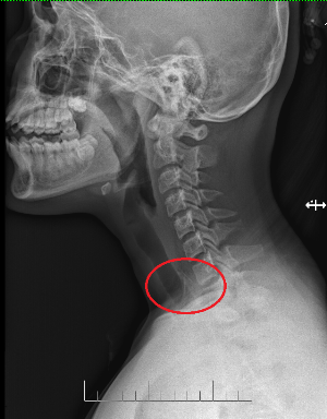 Vừa xem tivi vừa ăn, bé gái phải cấp cứu vì nuốt xương gà ảnh 1