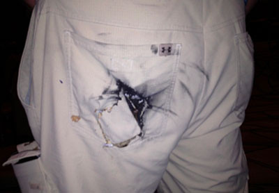 Hình ảnh pin điện thoại nổ, xé toạc túi quần nạn nhân