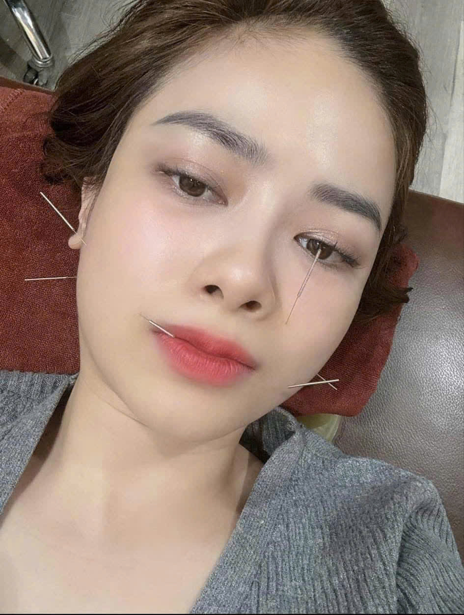 Nữ ca sĩ đã ổn hơn sau thời gian châm cứu kết hợp dùng thuốc. Nữ ca sĩ đã ổn hơn sau thời gian châm cứu kết hợp dùng thuốc.