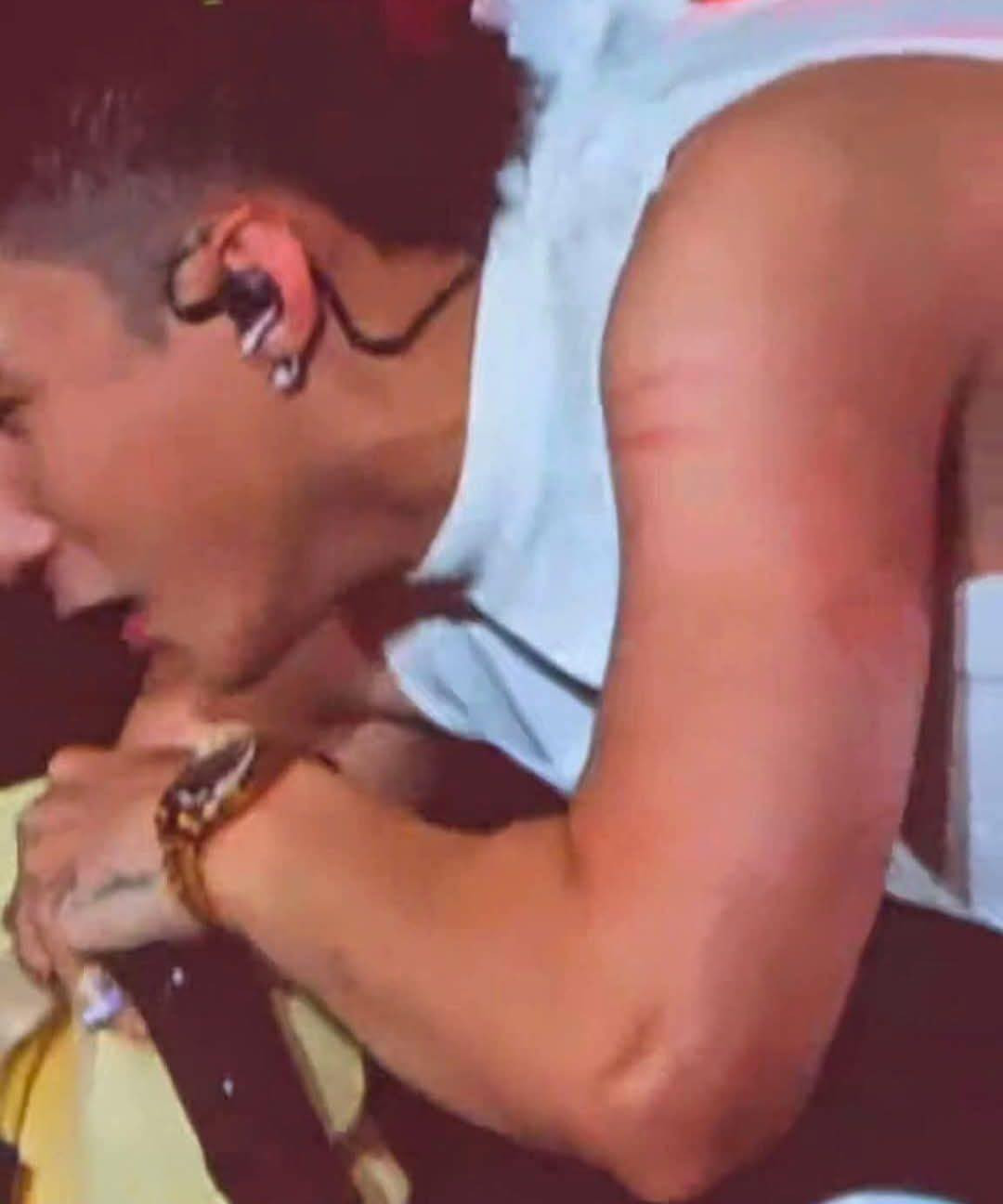 Vết hằn ở tay của Sơn Tùng khi bị khán giả ôm quá chặt. Vết hằn ở tay của Sơn Tùng khi bị khán giả ôm quá chặt.