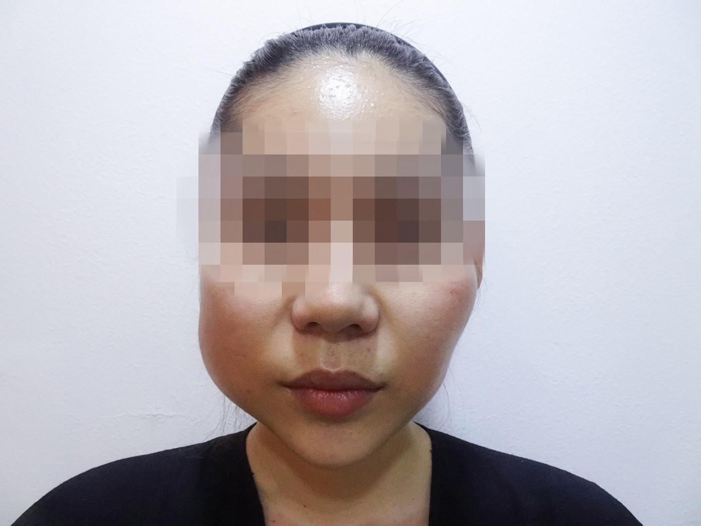 Gương mặt bệnh nhân bị biến dạng, sưng phù gây đau đớn khi đến bệnh viện thăm khám Gương mặt bệnh nhân bị biến dạng, sưng phù gây đau đớn khi đến bệnh viện thăm khám