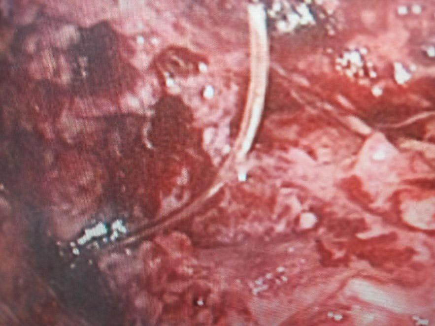 Chiếc xương cá xuyên thủng đại tràng được phát hiện trên hình ảnh camera phẫu thuật nội soi Chiếc xương cá xuyên thủng đại tràng được phát hiện trên hình ảnh camera phẫu thuật nội soi