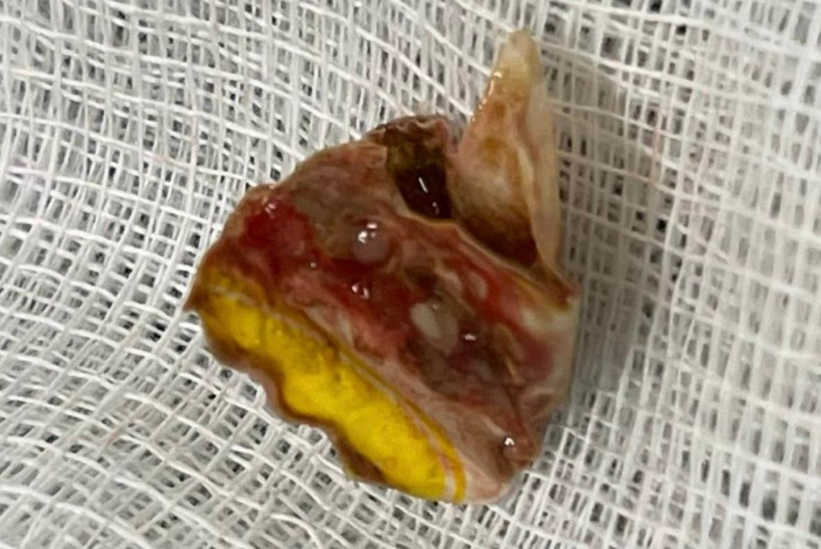 Mảnh vỏ kẹo nằm xếp lớp trong phổi là nguyên nhân khiến người bệnh bị ho ra máu dai dẳng Mảnh vỏ kẹo nằm xếp lớp trong phổi là nguyên nhân khiến người bệnh bị ho ra máu dai dẳng