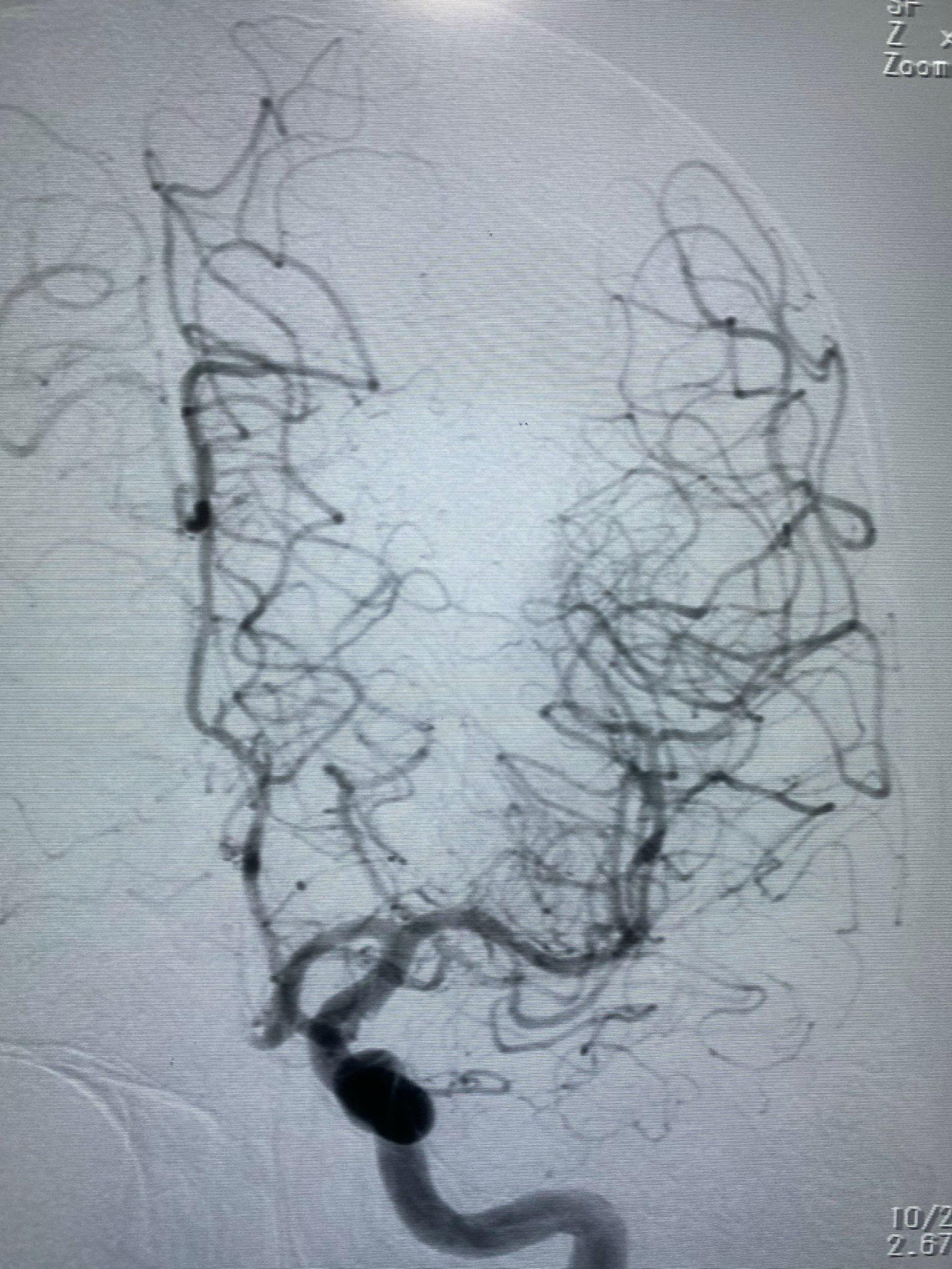 Mạch máu não của bệnh nhân sau khi được bác sĩ can thiệp tái thông