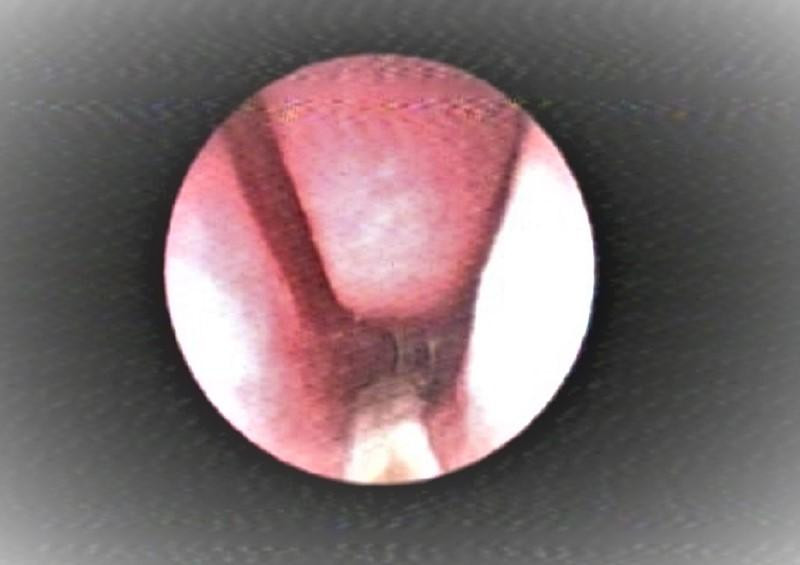 Hình ảnh sợi dây thun cột tóc được bác sĩ phát hiện trong mũi bệnh nhi qua nội soi Hình ảnh sợi dây thun cột tóc được bác sĩ phát hiện trong mũi bệnh nhi qua nội soi