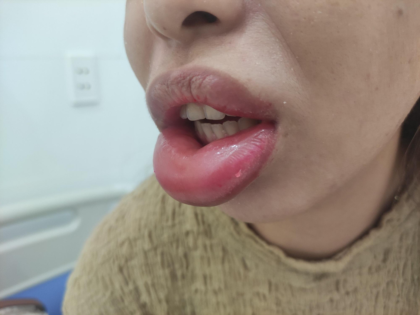 Nữ bệnh nhân nhập viện với bờ môi bị phù nề, đau đớn sau tiêm chất làm đầy