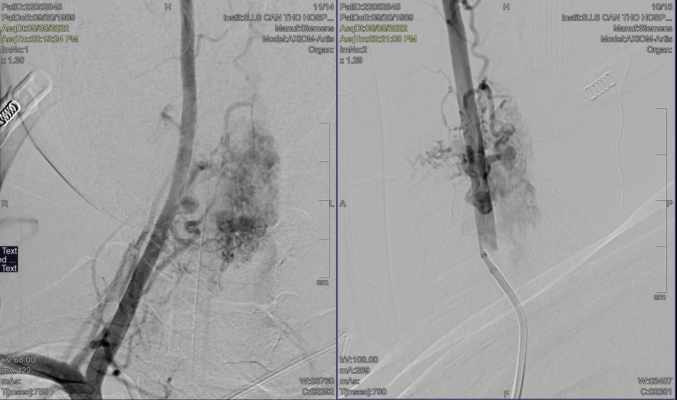 Hình ảnh DSA cho thấy, bệnh nhân bị dị dạng mạch máu tủy cổ gây yếu liệt tứ chi Hình ảnh DSA cho thấy, bệnh nhân bị dị dạng mạch máu tủy cổ gây yếu liệt tứ chi