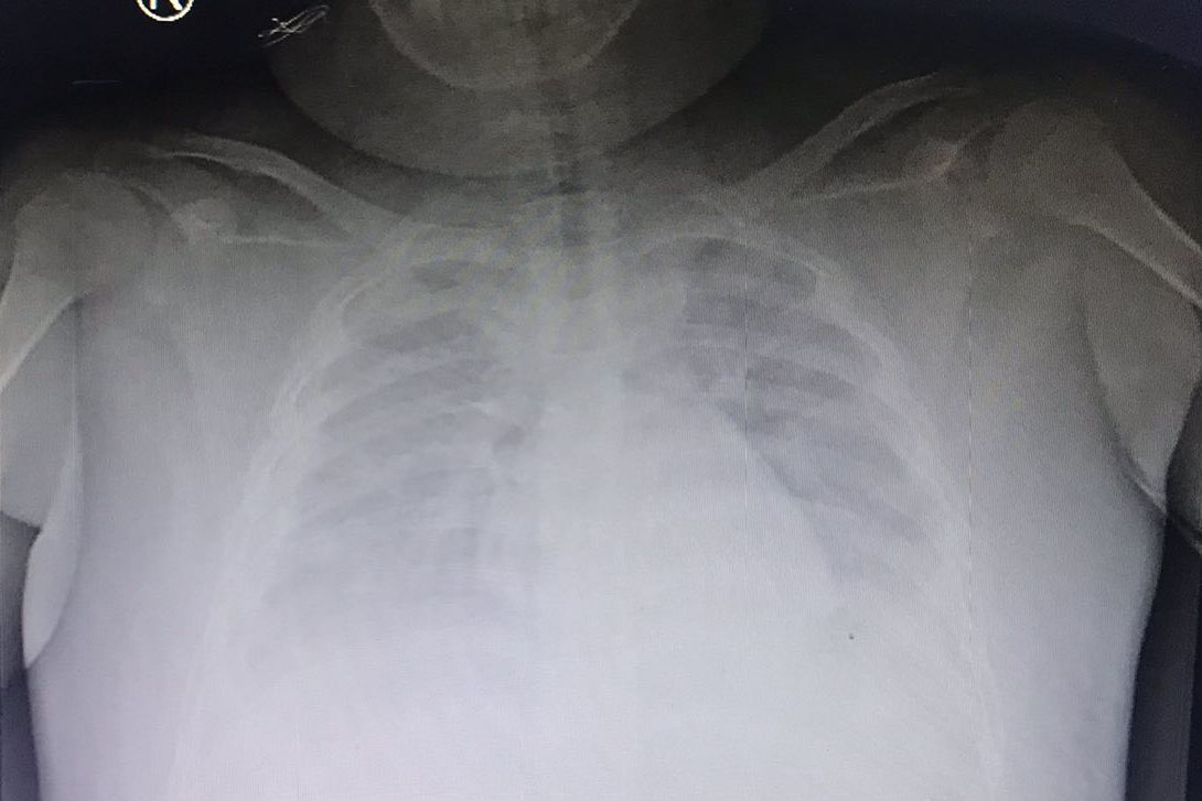 Kết quả X-quang phổi ghi nhận, bệnh nhi tràn dịch màng phổi, tổn thương phổi 2 bên Kết quả X-quang phổi ghi nhận, bệnh nhi tràn dịch màng phổi, tổn thương phổi 2 bên